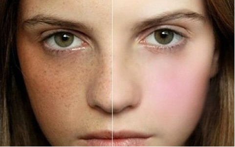 色斑的“前世今生”與科學淡化方案