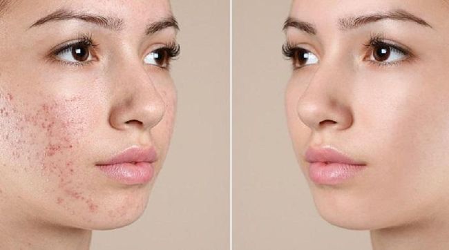 反復長痘，到底如何護膚？